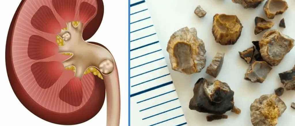 Böbrek Taşı Nasıl Düşer?