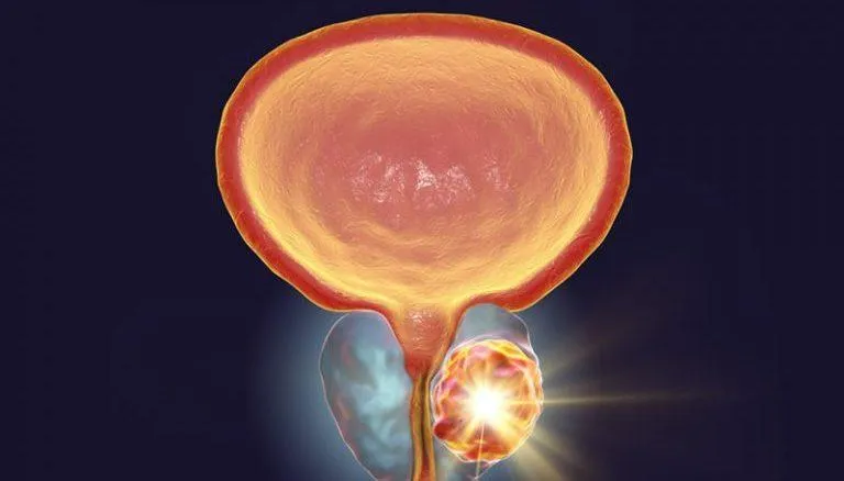 Prostat Kanseri Hakkında Bilmeniz Gereken Her Şey